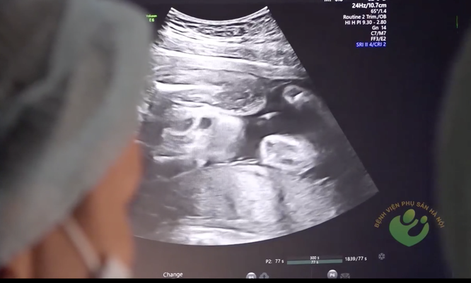 20 thai nhi được giành giật khỏi "bàn tay tử thần” bằng kỹ thuật truyền ối ảnh 3