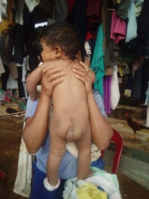 Bé trai 7 tháng tuổi người dân tộc Châu Mạ mang khối u khổng lồ ở mông ảnh 1