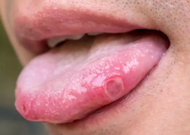 3 triệu chứng mới của những người nhiễm virus Corona ảnh 1