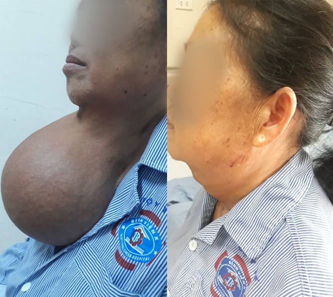 Nữ bệnh nhân có khối u to như quả bưởi ở trên cổ 20 năm ảnh 1