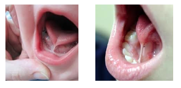 Mỗi ngày có khoảng 5-10 trẻ bị dính lưỡi phải vào viện để điều trị ảnh 1