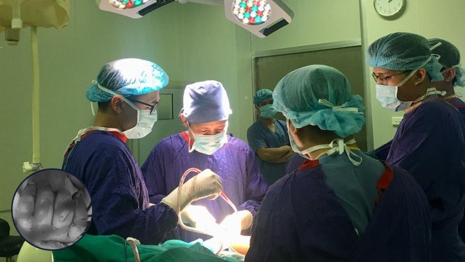 Các bác sĩ của Bệnh viện Hữu nghị Việt Đức vi phẫu bảo tồn bàn tay của bé trai 23 tháng tuổi.
