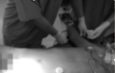 Bệnh nhân nhập viện trong tình trang nguy kịch vì bị 2 thanh sắt đâm xuyên người. Ảnh: BVCC