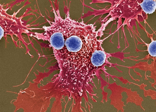 Liệu pháp mới được thông qua đột phá ở chỗ sử dụng các tế bào T đã chỉnh gen (xanh dương) để tấn công tế bào ung thư (màu đỏ) (Ảnh: Science Source)
