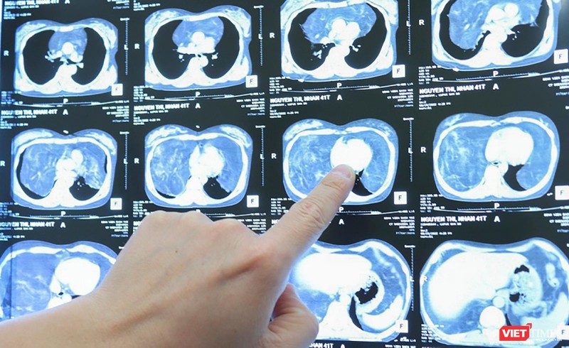 Hình ảnh khối u khổng lồ trong khoang ngực của bệnh nhân M.