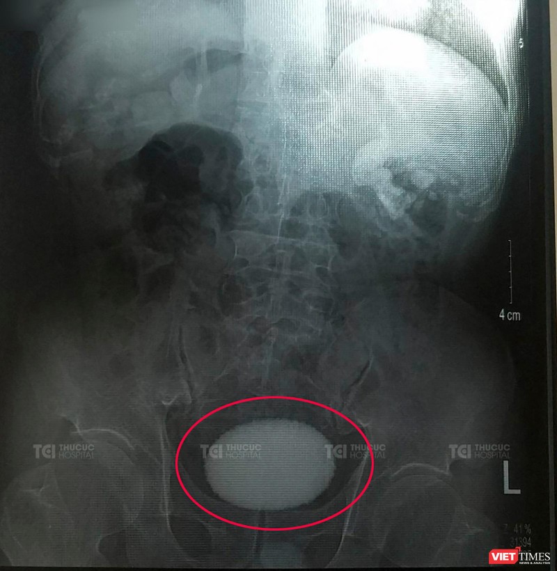 Viên sỏi bàng quang có hình dáng và kích thước tương tự như quả trứng vịt trên phim chụp X-Quang của bệnh nhân T. (ảnh BVCC)