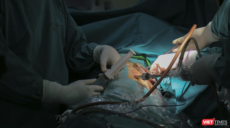 Ê-kíp bác sĩ phẫu thuật do Ths.Bs Nguyễn Văn Lâm – Khoa Ngoại tổng hợp, Bệnh viện đa khoa Đức Giang sử dụng kỹ thuật nội soi để bóc ổ cặn màng phổi nghi do di chứng COVID-19 cho bệnh nhân