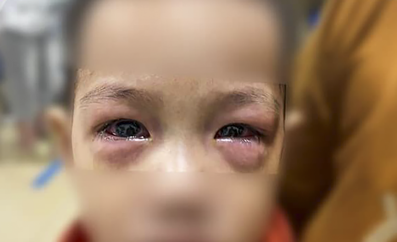 Trẻ bị đau mắt đỏ và gặp biến chứng nặng (ảnh BVCC)