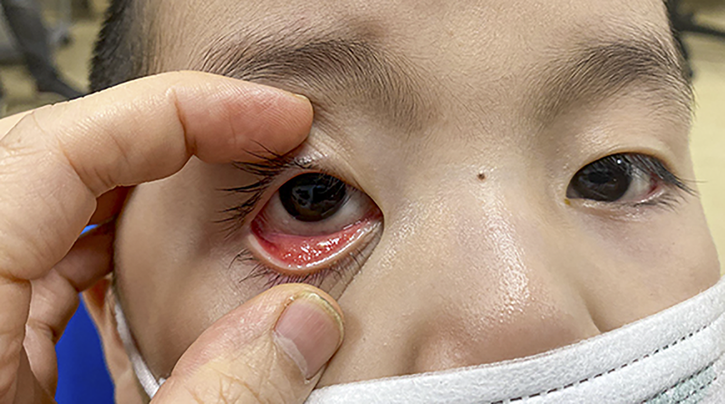 Người mắc bệnh đau mắt đỏ tuyệt đối không tự ý sử dụng các thuốc nhỏ mắt có chứa corticoid (ảnh BV Nhi TW)