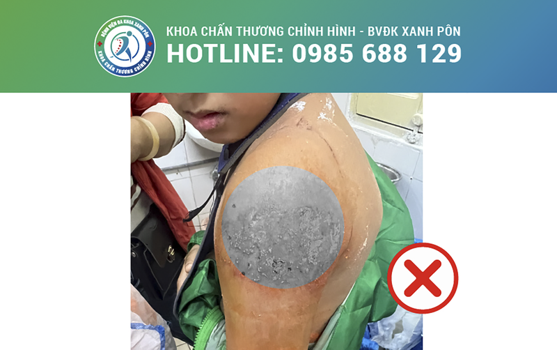 Bệnh viện đa khoa Xanh Pôn (Hà Nội) cảnh báo nguy hiểm tính mạng đối với người bệnh khi điều trị gãy xương bằng bó lá.