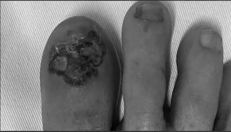 Ngón chân bệnh nhân bị có mảng màu đen, loét, rỉ dịch và chảy máu do ung thư tế bào hắc tố