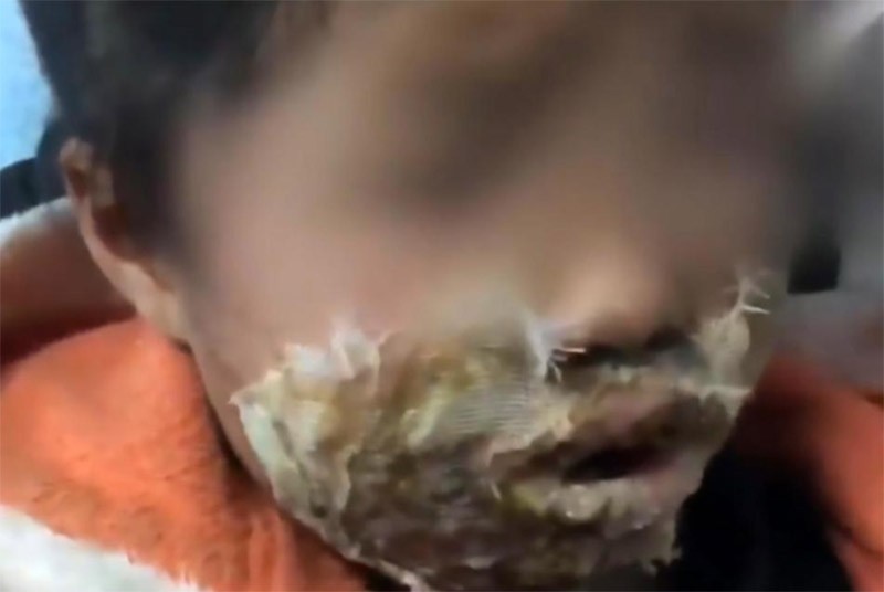Note 4 phát nổ làm bé gái bị bỏng trên khuôn mặt