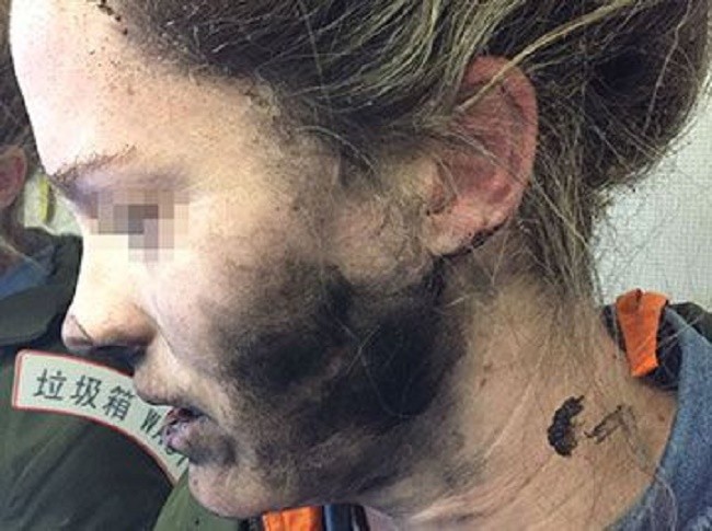 Một nữ hành khách người Australia đã bị bỏng vì tai nghe Apple phát nổ