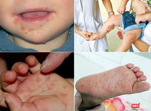 Chuyên gia y tế HCDC đưa ra hướng dẫn phòng tránh tay chân miệng cho trẻ
