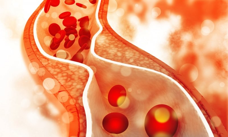 Có quá nhiều cholesterol trong máu ảnh hưởng lớn tới sức khỏe tim mạch.