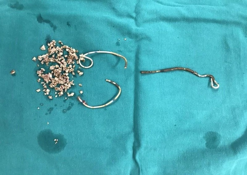 Đoạn stent jj gãy và sỏi lấy ra khỏi cơ thể bệnh nhân