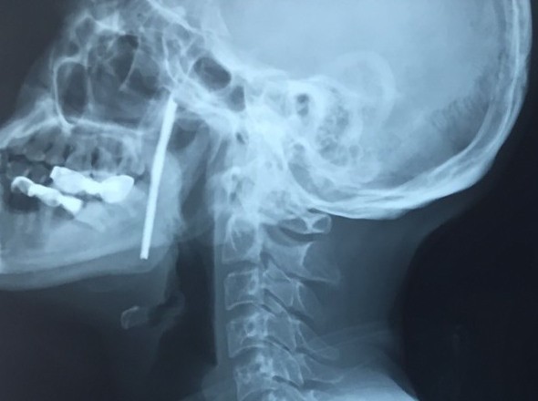 Ảnh chụp X-quang bệnh nhân bị thanh sắt cắm xuyên cổ. Ảnh: BVCC 