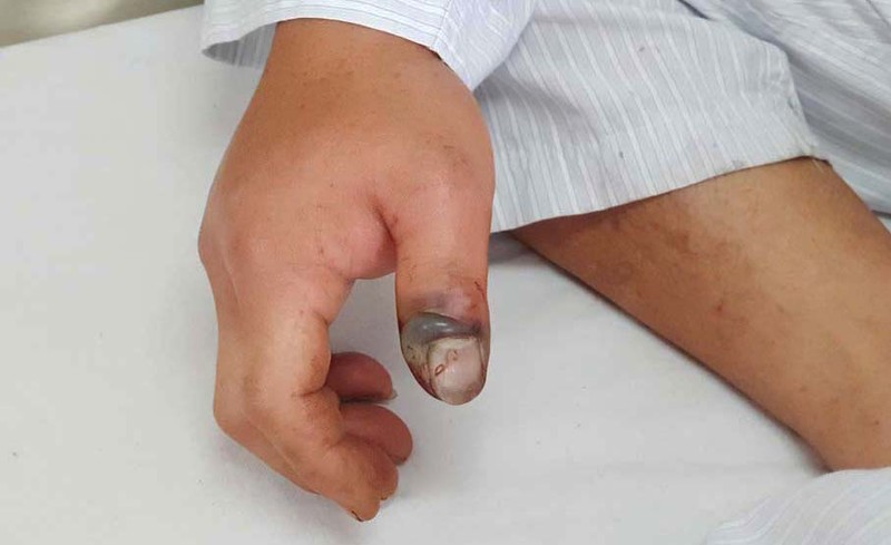Ngón cái bàn tay phải của bệnh nhân bị rắn cắn sưng đỏ, có dấu hiệu hoại tử. Ảnh: BVCC