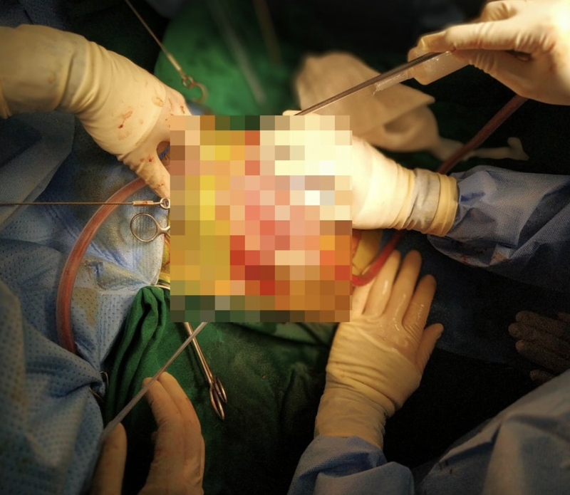 Các bác sĩ phẫu thuật ổ bụng cho bé gái bị thủng bụng, lộ toàn bộ ruột non (Ảnh - BVCC) 