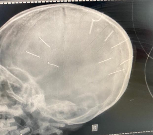Hình ảnh chụp X-Quang hộp sọ bệnh nhân với 9 hình thể nghi là đinh (Ảnh: Bệnh viện Đa khoa huyện Thạch Thất cung cấp)