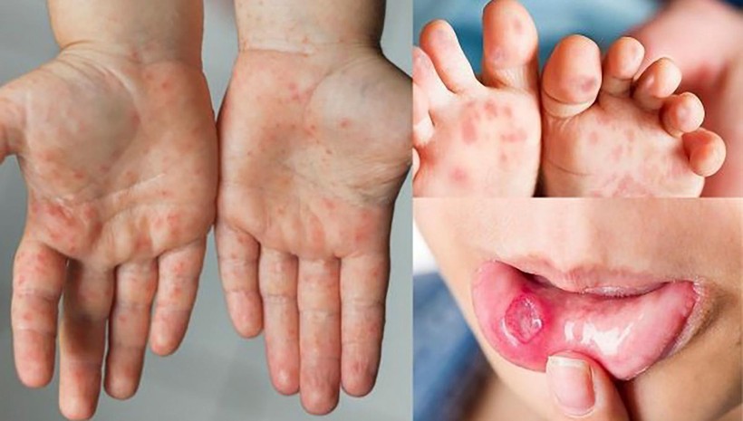 Bệnh tay chân miệng ở trẻ em (ảnh SKĐS)