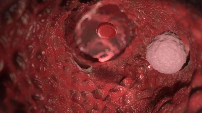Hình minh họa sự di căn cho thấy một cuộc xâm lược của các tế bào ung thư trong máu của một người.