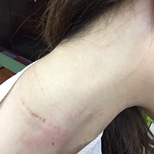 Vết thương trầy xước do bị hành hung trên cổ bà Nguyễn Lê Quỳnh Anh. (Ảnh: Thanh niên)