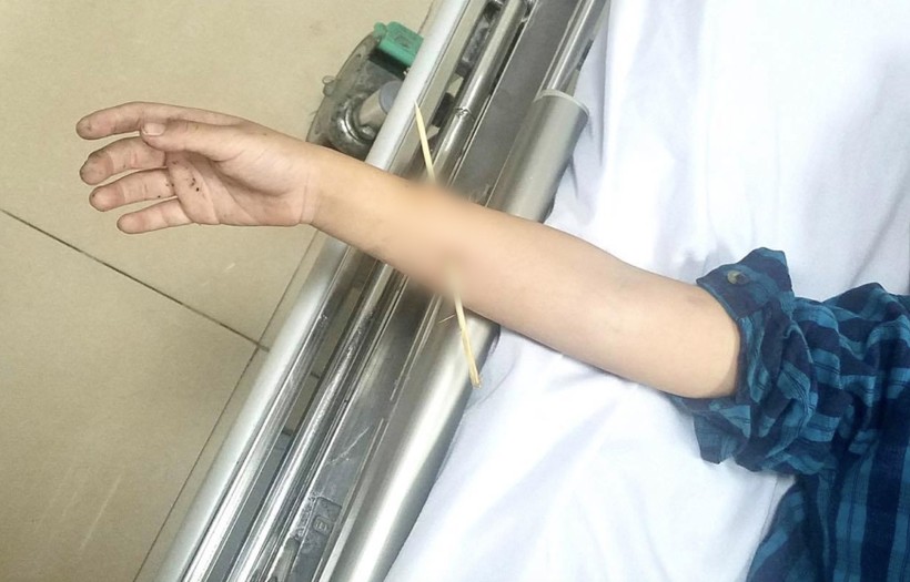 Bé trai 6 tuổi không may bị xiên tre đâm xuyên cẳng tay phải (Ảnh: BVCC)