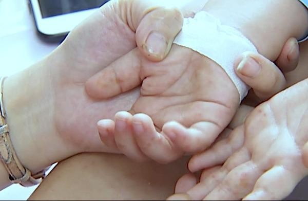 Trẻ mắc bệnh tay chân miệng có xu hướng gia tăng (Ảnh - Cục Y tế Dự phòng, BYT) 