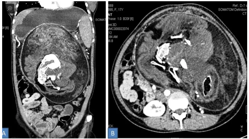 Hình ảnh CT scan trường hợp "thai nhi trong bào thai" được phát hiện bên trong bụng của một người phụ nữ Ấn Độ. Ảnh: Gizmodo