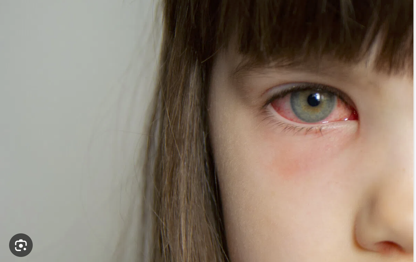 Hôm nay, Sở Y tế TP HCM công bố đã xác định được tác nhân gây bệnh đau mắt đỏ trên địa bàn