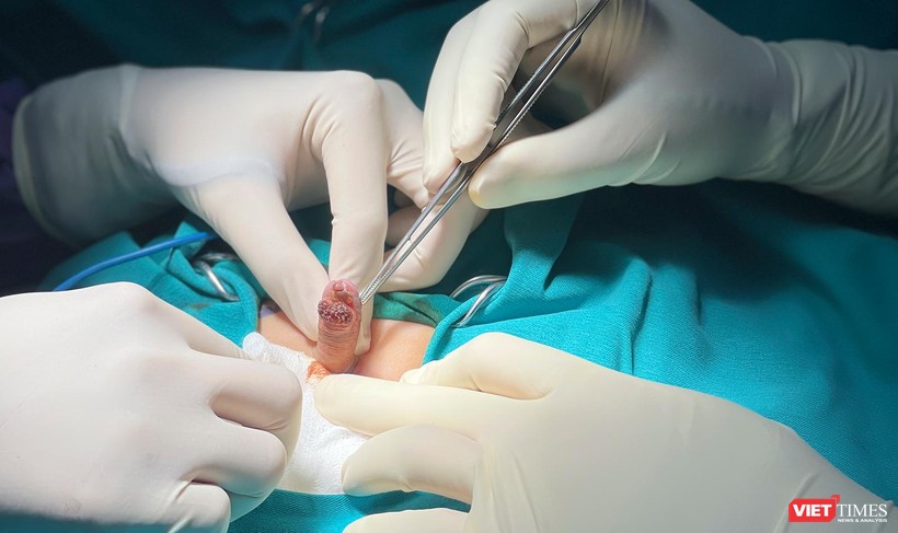 Ca phẫu thuật cắt bỏ khối sùi mào gà dương vật cho bệnh nhi 6 tuổi, giúp bệnh nhân tránh nguy cơ cắt cụt dương vật.