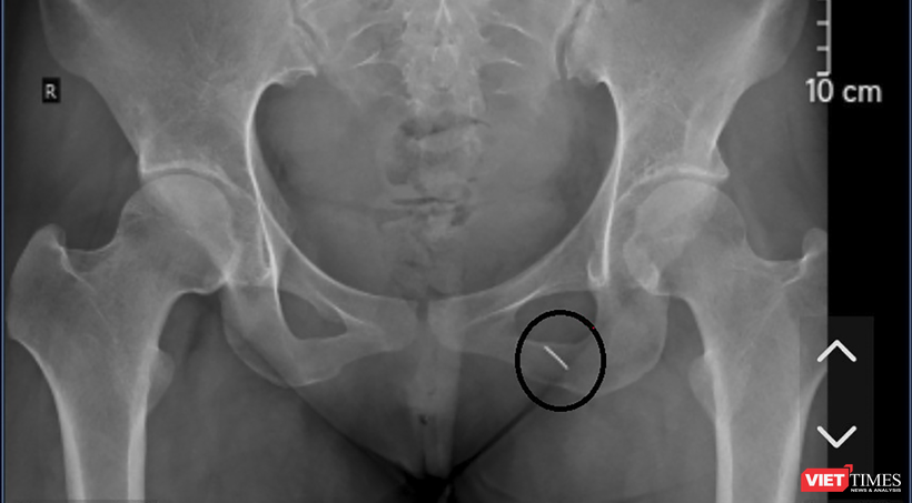 Phim X-quang thể hiện cây kim may đâm và chui sâu vào cơ thể bệnh nhân