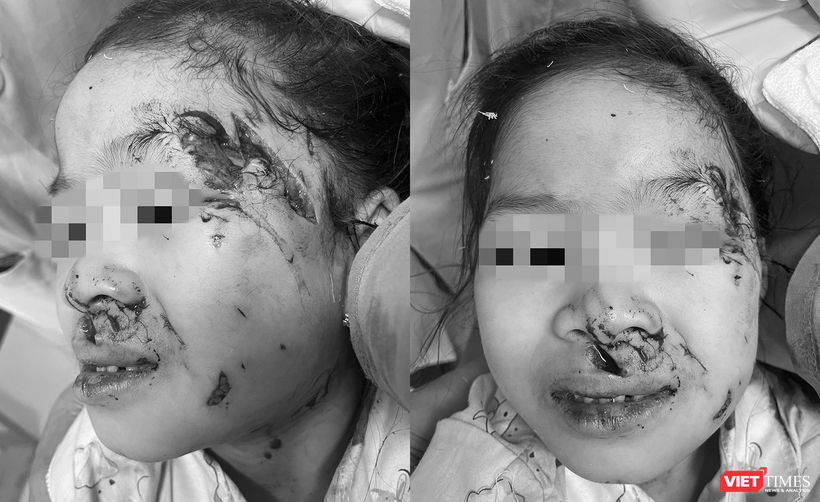 Bệnh nhi Nguyễn Ánh L. bị chó cắn tổn thương nặng vùng đầu và mặt
