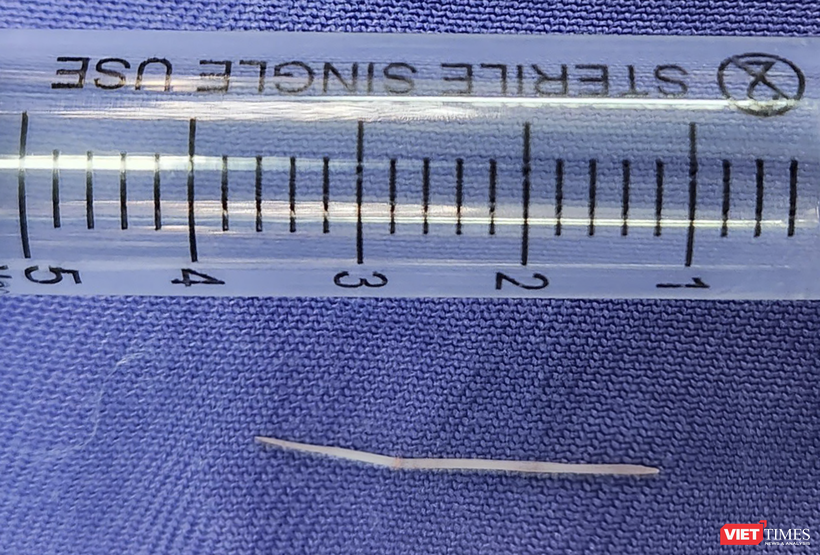 Chiếc xương cá dài 2,5cm được lấy từ sàn miệng bệnh nhân