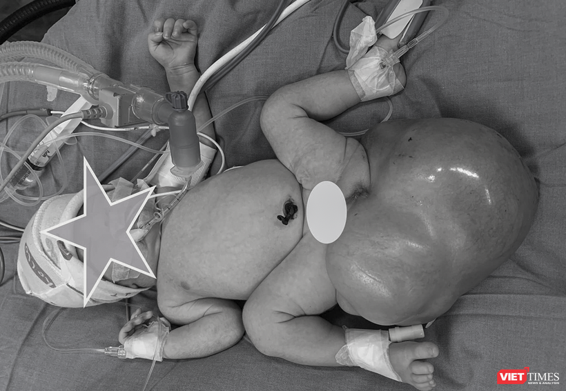 Bé gái 5 ngày tuổi mắc khối u nặng hơn 1,2kg được phát hiện từ trong bào thai mẹ. (Ảnh BVCC)