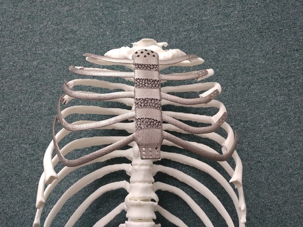 Ca ghép xương ngực nhân tạo bằng công nghệ in 3D đầu tiên tại Hàn Quốc. Ảnh: koreabiomed.com
