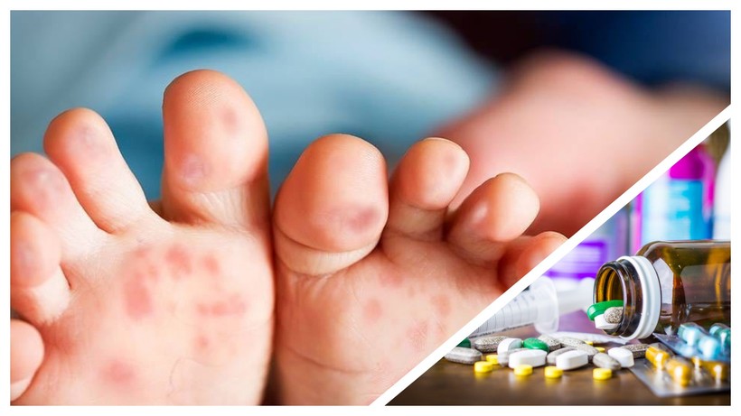 Có thông tin cho rằng thiếu thuốc điều trị bệnh tay chân miệng đang vào mùa cao điểm ở TP.HCM (Ảnh CarePlus, Hòa Bình ghép) 