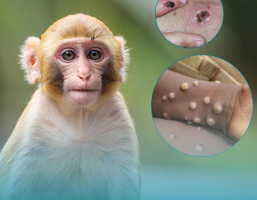 Bộ Y tế đề nghị các địa phương siết chặt giám sát bệnh đậu mùa khỉ (ảnh TH)