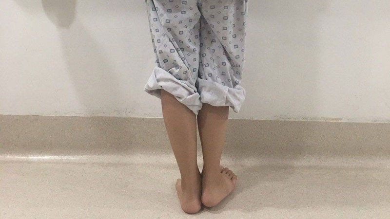 Sau lần phẫu thuật cách đây 4 năm, nữ sinh Đỗ Thị Kim C. phải chịu đôi chân lệch nhau 2 cm, dáng đi tập tễnh khiến em tự ti.