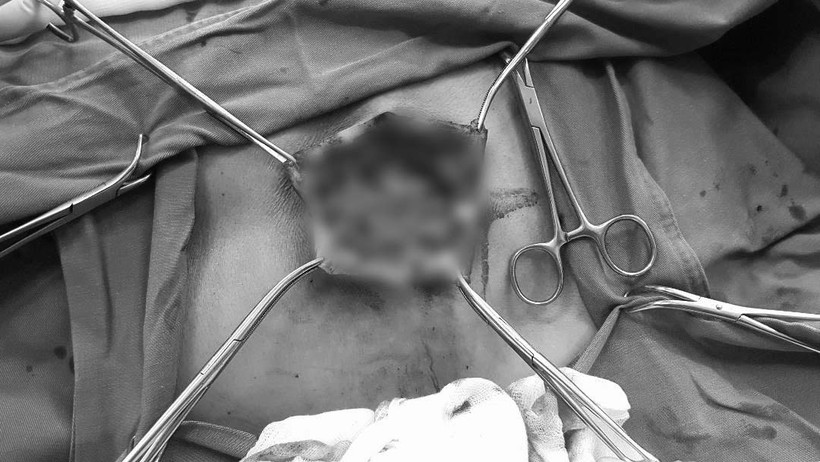 Hình ảnh bệnh nhân hậu bối lớn lưng được phẫu thuật. Ảnh: Bệnh viện Hữu nghị Việt Đức 