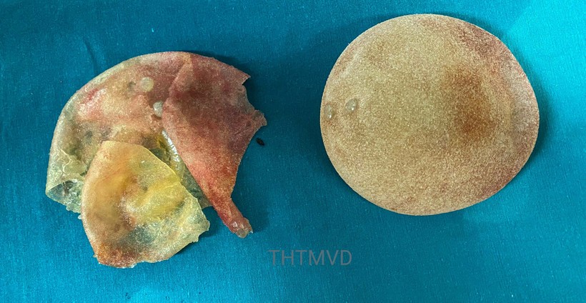 Túi ngực vỡ của chị V. được lấy ra sau 5 năm phẫu thuật nâng ngực (Ảnh - Bệnh viện Hữu nghị Việt Đức) 