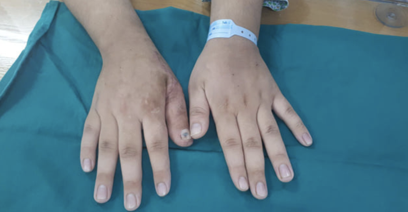Bàn tay của bệnh nhân sau phẫu thuật (Ảnh: BVCC) 