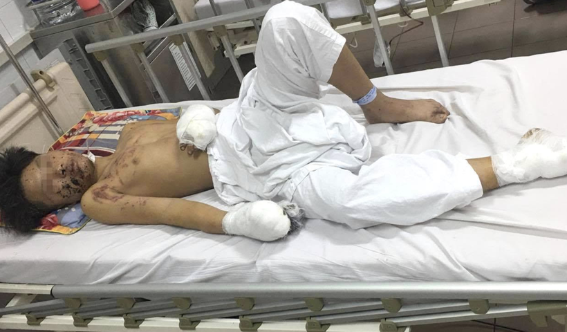 Thiếu niên 15 tuổi chấn thương nặng vì pháo tự chế phát nổ (Ảnh: BVCC) 