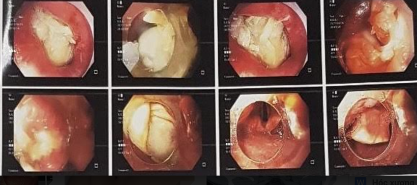Hình ảnh xương gà mắc trong cổ họng bệnh nhân (Ảnh - BVCC) 